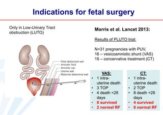 Indications for fetal surgery
Only in Low-Urinary Tract
obstruction (LUTO)

Morris et al. Lancet 2013:
Results of PLUTO trial:
N=31 pregnancies with PUV,
16 – vesicoamniotic shunt (VAS)
15 – concervative treatment (CT)

•
•
•
•
•

VAS:
1 intrauterine death
3 TOP
4 death <28
days
8 survived
2 normal RF

•
•
•
•
•

CT:
1 intrauterine death
2 TOP
8 death <28
days
4 survived
0 normal RF

 