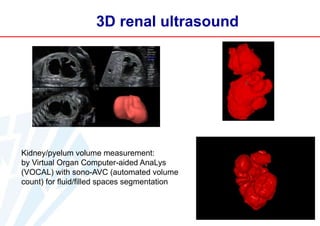3D renal ultrasound

Kidney/pyelum volume measurement:
by Virtual Organ Computer-aided AnaLys
(VOCAL) with sono-AVC (automated volume
count) for fluid/filled spaces segmentation

 