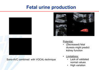Fetal urine production

Potential:
• (Decreased) fetal
diuresis might predict
kidney function

Sono-AVC combined with VOCAL-technique

• Limitations:
• Lack of validated
normal values
• High variation

 