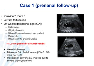 Case 1 (prenanal follow-up)
• Gravida 2, Para 0
• In vitro fertilization
• 24 weeks gestational age (GA):
– Male foetus
– Oligohydramnios
– Bilateral hydroureteronephrosis grade 4
– Megacystis
– Dilatation of the proximal urethra

 LUTO (posterior urethral valves)
• Weekly follow-up
• 26 weeks GA: foetal serum 2-MG: 5.9
mg/L (ref <4.9
• Induction of delivery at 34 weeks due to
severe oligohydramnios

 