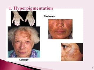 13
1. Hyperpigmentation
 