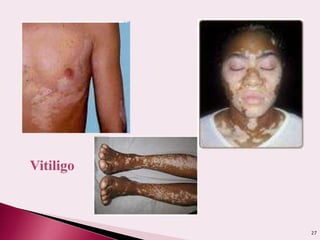27
Vitiligo
 