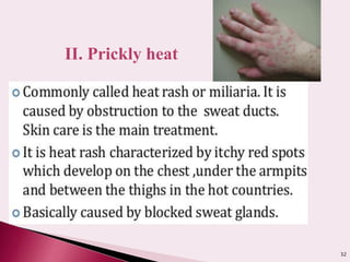 32
II. Prickly heat
 