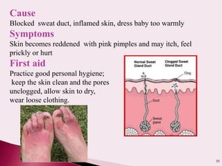 35
Cause
Blocked sweat duct, inflamed skin, dress baby too warmly
Symptoms
Skin becomes reddened with pink pimples and may itch, feel
prickly or hurt
First aid
Practice good personal hygiene;
keep the skin clean and the pores
unclogged, allow skin to dry,
wear loose clothing.
 
