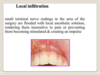 Local Infiltration Location Injection local anesthesia | PPT