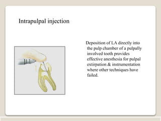 Intrapulpal local anesthesia | PPT