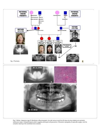Fig. 1The family
Fig. 2 Mother: diagnosis at age 23. Mandibular x-Ray tomography: the right ramus (a) and the left ramus (b) show bilateral and symmetric
radiolucenct areas.c Histopathological pattern suggests central giant cell granuloma. d Panoramic radiography 23 years after surgery; note the
complete restoring of the mandibular bone structure
 