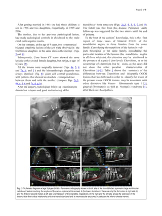 After getting married in 1995 she had three children: a
son in 1996 and two daughters, respectively, in 1999 and
2006.
The mother, due to her previous pathological lesion,
had made radiological controls in childhood to the male
child, with negative results.
On the contrary, at the age of 9 years, two symmetrical
bilateral osteolytic lesions of the jaw were observed in the
first female daughter, in the same sites as the mother (Figs.
3 and 4).
Subsequently, Cone beam CT scans showed the same
lesions to the second female daughter, but earlier, at age of
6 years [5].
All the lesions were surgically removed (Figs. 4a, 5, 6
and 7a, b, and f ) and the histopathologic diagnosis was
always identical (Fig. 8): giant cell central granulomas,
with patterns that showed an absolute correspondence
between them and with the mother (compare Figs. 2c,3,
4b, c, 5, 6 and 7c, d, g, h).
After the surgery, radiological follow-up examinations
showed no relapses and good restructuring of the
mandibular bone structure (Figs. 2c,3, 4, 5, 6, 7 and 9).
The father was free from this disease. Periodical yearly
follow-up was suggested for the two sisters until the end
of puberty.
To the best of the authors’ knowledge, this is the first
report of three cases of bilateral CGCG of the
mandibular angles in three females from the same
family. Considering the repetition of the lesion in sub-
jects belonging to the same family, considering the
particular location of the lesions (the mandibular angles
in all three subjects), this situation may be attributed to
the presence of a grade I (low level) Cherubism, or to the
occurrence of cherubism-like le- sions, as the cases did
not show the other peculiar characteristics of
Cherubism [6–8]. Table 1 shows the summary of the
differences between Cherubism and idiopathic CGCG
lesions that was followed in order to classify the lesion of
the present cases. CGCG lesions may be associated with
other disorders like Neuro- fibromatosis type 1 [3],
gingival fibromatosis as well as Noonan’s syndrome [4],
all of them are Rasopathies.
Fig. 3 TA,female, diagnosis at age 9 (4-gen-2008)-a Panoramic radiography shows on both side of the mandible two symmetric large multilocular
radiolucent lesions involving the angle and the ramus regions (white arrows). In the lower dental arch, there are only the first molar at right side (b)
and the first and second molars at left side (c) CTCBstudy of the mandible, respectively, of the right and the left site, shows the extension of the
lesions. Note their critical relationship with the mandibular canal and its neurovascular structures, in particular the inferior alveolar nerves
Page 3 of 8
 