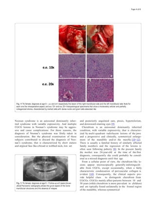 Noonan syndrome is an autosomal dominantly inher-
ited syndrome with variable expressivity. And multiple
CGCG lesions in Noonan’s syndrome may be aggres-
sive and cause complications. For these reasons, the
diagnosis of Noonan’s syndrome was firstly taken in
consideration. But the physical examination of these
subjects contributed to discard the diagnosis of Noo-
nan’s syndrome, that is characterized by short stature
and atypical face like a broad or webbed neck, low set
and posteriorly angulated ears, ptosis, hypertelorism,
and downward-slanting eyes [9].
Cherubism is an autosomal dominantly inherited
condition, with variable expressivity, that is character-
ized by multi-quadrant radiolucent lesions of the jaws
and a progressive and clinically, symmetrical enlarge-
ment of the mandible and/or the maxilla [10–12].
There is usually a familial history of similarly affected
family members and the regression of the lesions is
often seen following puberty [8]. In the present family
the mother was 24-year-old at the time of the first
diagnosis, consequently she could probably be consid-
ered as a missed diagnosis until that age.
From a cellular point of view, the cherubism-like le-
sions appear microscopically generally indistinguish-
able from CGCG, except occasionally, when a fairly
characteristic condensation of perivascular collagen is
evident [10]. Consequently, the clinical aspects pro-
vide helpful clues to distinguish cherubism from
CGCGs. CGCGs mainly affect patients between 10 and
30 years (while cherubism is more prevalent in children)
and are typically found unilaterally in the frontal region
of the mandible, whereas symmetrical
Fig. 4 TA, female, diagnosis at age 9 – a-c and d-f: respectively the lesion of the right mandibular side and the left mandibular side. Note for
each one the intraoperative aspect, and e.e. 10× and e.e. 20× histopatological speciments that show a moderately cellular and partially
collagenized stroma, characterized by melted cells with dense nuclei and giant cells osteoclast like
Fig. 5 TA, female, diagnosis at age 9 – Follow-up at 5 years (16-avr-
2013).Panoramic radiography shows the good aspect of the bone
mandibular structures and the absence of relapse
Page 4 of 8
 