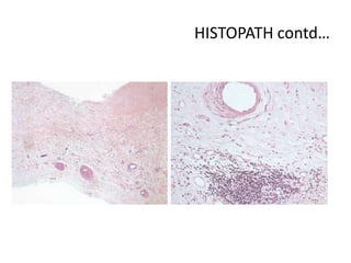 Caseation Hitopath Mitral valve pathophysiology | PPTX