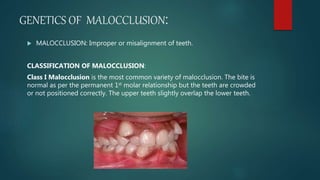 GENETICS OF MALOCCLUSION:
 MALOCCLUSION: Improper or misalignment of teeth.
CLASSIFICATION OF MALOCCLUSION:
Class I Malocclusion is the most common variety of malocclusion. The bite is
normal as per the permanent 1st molar relationship but the teeth are crowded
or not positioned correctly. The upper teeth slightly overlap the lower teeth.
 