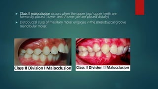  Class II malocclusion occurs when the upper jaw/ upper teeth are
forwardly placed ( lower teeth/ lower jaw are placed distally)
 Distobuccal cusp of maxillary molar engages in the mesiobuccal groove
mandibular molar.
 