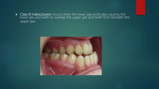  Class III malocclusion occurs when the lower jaw protrudes causing the
lower jaw and teeth to overlap the upper jaw and teeth from beneath the
upper jaw.
 