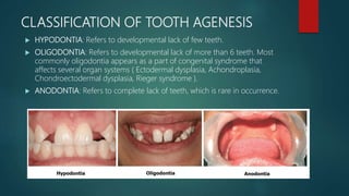 CLASSIFICATION OF TOOTH AGENESIS
 HYPODONTIA: Refers to developmental lack of few teeth.
 OLIGODONTIA: Refers to developmental lack of more than 6 teeth. Most
commonly oligodontia appears as a part of congenital syndrome that
affects several organ systems ( Ectodermal dysplasia, Achondroplasia,
Chondroectodermal dysplasia, Rieger syndrome ).
 ANODONTIA: Refers to complete lack of teeth, which is rare in occurrence.
 