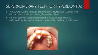 SUPERNUMERARY TEETH OR HYPERDONTIA:
 HYPERDONTIA is the condition of having SUPERNUMERARY TEETH or teeth
which appear in addition to the regular number of teeth.
 The most common supernumerary tooth is a MESIODENS which is a
malformed, peg like tooth that occurs between the maxillary central incisors.
 