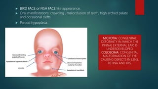  BIRD FACE or FISH FACE like appearance.
 Oral manifestations: crowding , malocclusion of teeth, high arched palate
and occasional clefts.
 Parotid hypoplasia.
MICROTIA: CONGENITAL
DEFORMITY IN WHICH THE
PINNA( EXTERNAL EAR) IS
UNDERDEVELOPED.
COLOBOMA: CONGENITAL
MALFORMATION OF EYE
CAUSING DEFECTS IN LENS,
RETINA AND IRIS.
 