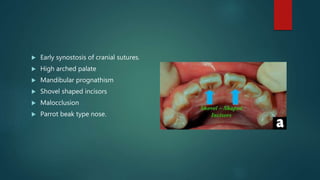  Early synostosis of cranial sutures.
 High arched palate
 Mandibular prognathism
 Shovel shaped incisors
 Malocclusion
 Parrot beak type nose.
 
