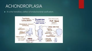 ACHONDROPLASIA
 It is the hereditary defect of endochondral ossification.
 