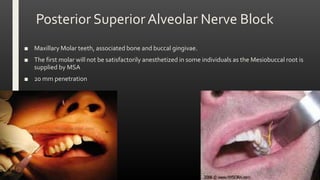 Posterior Superior Alveolar Nerve Block
■ Maxillary Molar teeth, associated bone and buccal gingivae.
■ The first molar will not be satisfactorily anesthetized in some individuals as the Mesiobuccal root is
supplied by MSA
■ 20 mm penetration
 