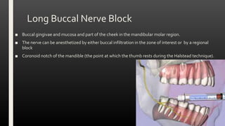 Long Buccal Nerve Block
■ Buccal gingivae and mucosa and part of the cheek in the mandibular molar region.
■ The nerve can be anesthetized by either buccal infiltration in the zone of interest or by a regional
block
■ Coronoid notch of the mandible (the point at which the thumb rests during the Halstead technique).
 