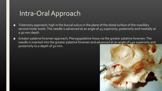 Intra-OralApproach
■ Tuberosity approach; high in the buccal sulcus in the plane of the distal surface of the maxillary
second molar tooth.The needle is advanced at an angle of 45 superiorly, posteriorly and medially at
a 30 mm depth
■ Greater palatine foramen approach; Pterygopalatine fossa via the greater palatine foramen.The
needle is inserted into the greater palatine foramen and advanced at an angle of 45o superiorly and
posteriorly to a depth of 30 mm.
 
