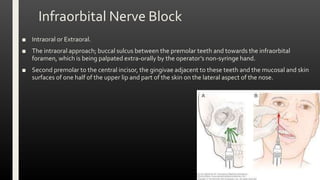 Infraorbital Nerve Block
■ Intraoral or Extraoral.
■ The intraoral approach; buccal sulcus between the premolar teeth and towards the infraorbital
foramen, which is being palpated extra-orally by the operator’s non-syringe hand.
■ Second premolar to the central incisor, the gingivae adjacent to these teeth and the mucosal and skin
surfaces of one half of the upper lip and part of the skin on the lateral aspect of the nose.
 