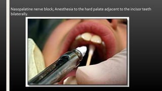 Nasopalatine nerve block;Anesthesia to the hard palate adjacent to the incisor teeth
bilaterally.
 