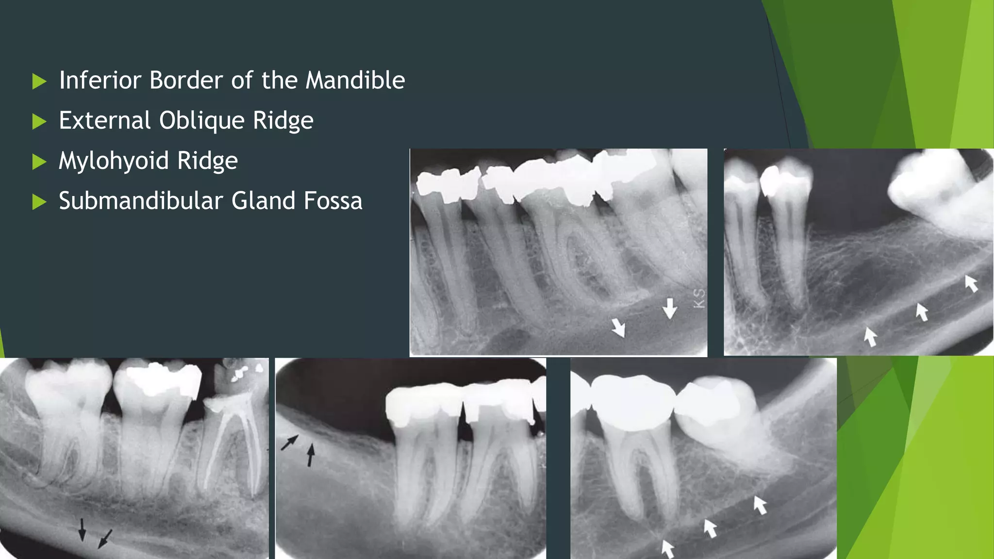 Normal Radiographic Anatomy of Oral Structures | PPTX