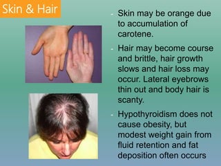 - Skin may be orange due
to accumulation of
carotene.
- Hair may become course
and brittle, hair growth
slows and hair loss may
occur. Lateral eyebrows
thin out and body hair is
scanty.
- Hypothyroidism does not
cause obesity, but
modest weight gain from
fluid retention and fat
deposition often occurs
Skin & Hair
 
