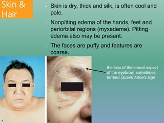 Skin &
Hair
- Skin is dry, thick and silk, is often cool and
pale.
- Nonpitting edema of the hands, feet and
periorbital regions (myxedema). Pitting
edema also may be present.
- The faces are puffy and features are
coarse.
the loss of the lateral aspect
of the eyebrow, sometimes
termed Queen Anne's sign
 