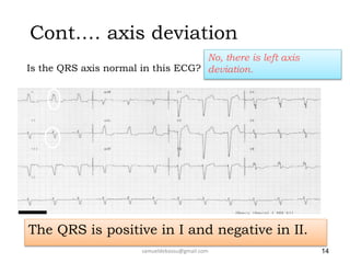 Cont.… axis deviation
Is the QRS axis normal in this ECG?
14
No, there is left axis
deviation.
The QRS is positive in I and negative in II.
samueldebassu@gmail.com
 