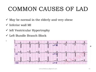 COMMON CAUSES OF LAD
 May be normal in the elderly and very obese
 Inferior wall MI
 left Ventricular Hypertrophy
 Left Bundle Branch Block
 Emphysema
samueldebassu@gmail.com 15
 