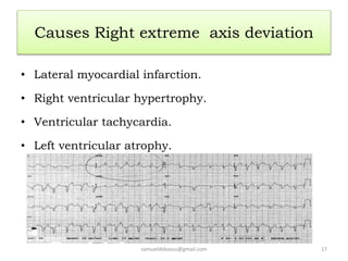 Causes Right extreme axis deviation
• Lateral myocardial infarction.
• Right ventricular hypertrophy.
• Ventricular tachycardia.
• Left ventricular atrophy.
samueldebassu@gmail.com 17
 
