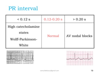 PR interval
< 0.12 s 0.12-0.20 s > 0.20 s
High catecholamine
states
Wolff-Parkinson-
White
Normal AV nodal blocks
19
Wolff-Parkinson-White 1st Degree AV Block
samueldebassu@gmail.com
 