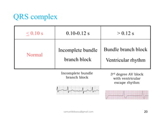 QRS complex
< 0.10 s 0.10-0.12 s > 0.12 s
Normal
Incomplete bundle
branch block
Bundle branch block
Ventricular rhythm
20
3rd degree AV block
with ventricular
escape rhythm
Incomplete bundle
branch block
samueldebassu@gmail.com
 