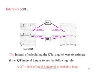 Intervals cont..
24
Tip: Instead of calculating the QTc, a quick way to estimate
if the QT interval long is to use the following rule:
A QT > half of the RR interval is probably long.
Normal QT Long QT
QT
RR
10 boxes
23 boxes 17 boxes
13 boxes
samueldebassu@gmail.com
 