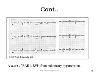 Cont..
samueldebassu@gmail.com 28
A cause of RAE is RVH from pulmonary hypertension.
 