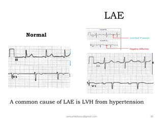LAE
Normal
samueldebassu@gmail.com 30
A common cause of LAE is LVH from hypertension
 