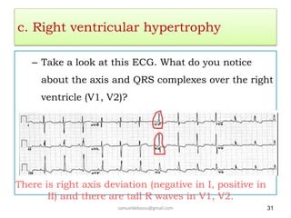 c. Right ventricular hypertrophy
– Take a look at this ECG. What do you notice
about the axis and QRS complexes over the right
ventricle (V1, V2)?
samueldebassu@gmail.com 31
There is right axis deviation (negative in I, positive in
II) and there are tall R waves in V1, V2.
 