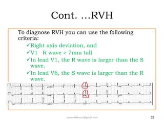 Cont. …RVH
To diagnose RVH you can use the following
criteria:
Right axis deviation, and
V1 R wave > 7mm tall
In lead V1, the R wave is larger than the S
wave.
In lead V6, the S wave is larger than the R
wave.
samueldebassu@gmail.com 32
 