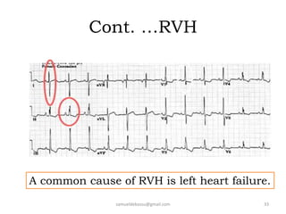 Cont. …RVH
samueldebassu@gmail.com 33
A common cause of RVH is left heart failure.
 