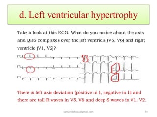 d. Left ventricular hypertrophy
Take a look at this ECG. What do you notice about the axis
and QRS complexes over the left ventricle (V5, V6) and right
ventricle (V1, V2)?
There is left axis deviation (positive in I, negative in II) and
there are tall R waves in V5, V6 and deep S waves in V1, V2.
samueldebassu@gmail.com 34
 