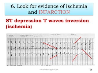 6. Look for evidence of ischemia
and INFARCTION
ST depression T waves inversion
(ischemia)
samueldebassu@gmail.com 38
 