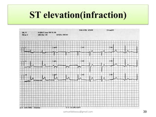 ST elevation(infraction)
39
samueldebassu@gmail.com
 