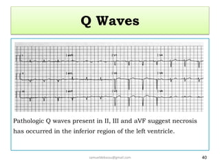 Q Waves
Pathologic Q waves present in II, III and aVF suggest necrosis
has occurred in the inferior region of the left ventricle.
samueldebassu@gmail.com 40
 
