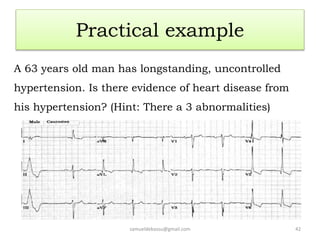 Practical example
A 63 years old man has longstanding, uncontrolled
hypertension. Is there evidence of heart disease from
his hypertension? (Hint: There a 3 abnormalities)
samueldebassu@gmail.com 42
 