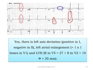 samueldebassu@gmail.com 43
Yes, there is left axis deviation (positive in I,
negative in II), left atrial enlargement (> 1 x 1
boxes in V1) and LVH (R in V5 = 27 + S in V2 = 10
 > 35 mm).
 