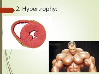 2. Hypertrophy:
 