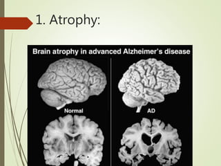 1. Atrophy:
 