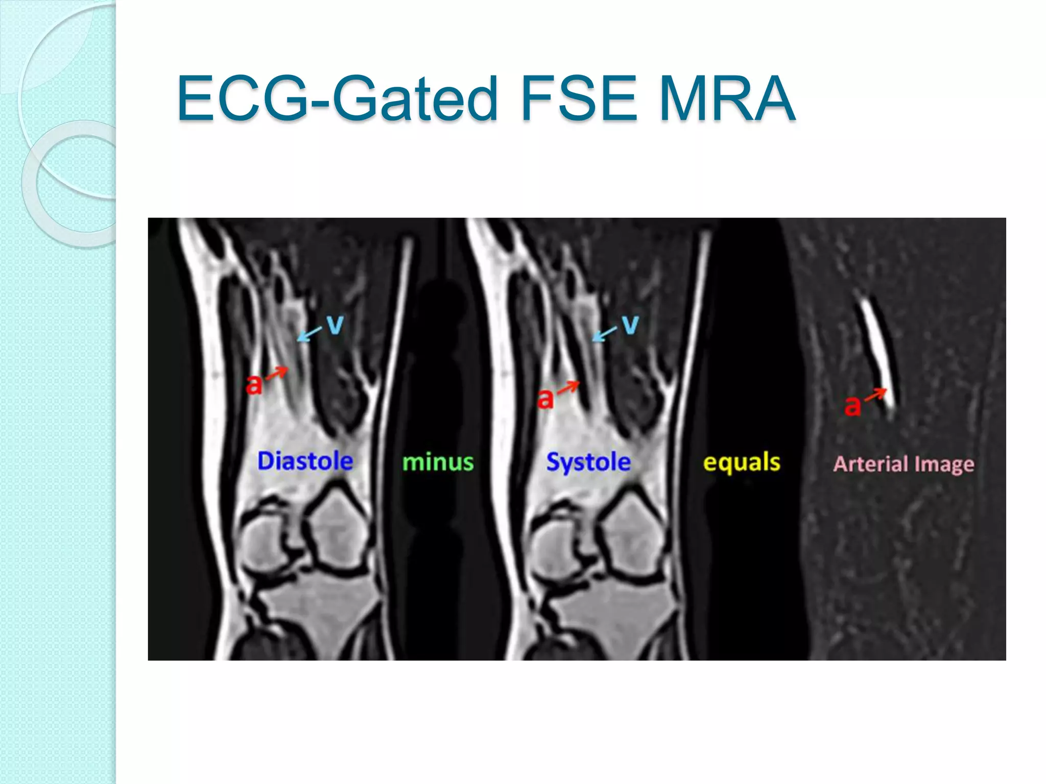 ECG-Gated FSE MRA
 